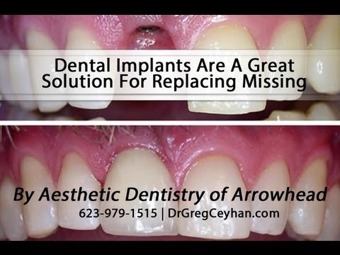 Why Dental Implants Are A Great Solution For Replacing Missing Teeth