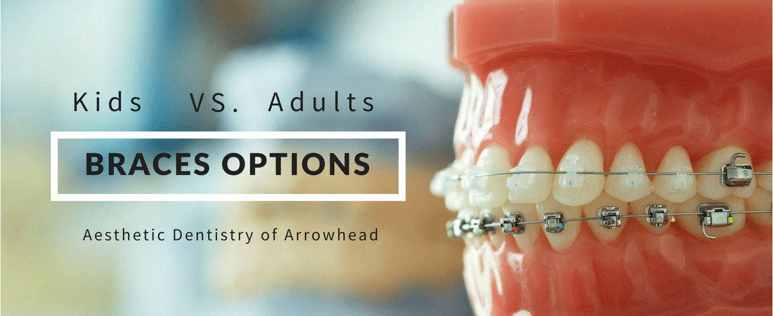 Options when it comes to braces for adults?